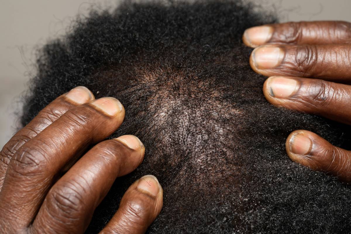 Close-up of healthy scalp with visible hair restoration in progress showing dense new baby hairs along the hairline